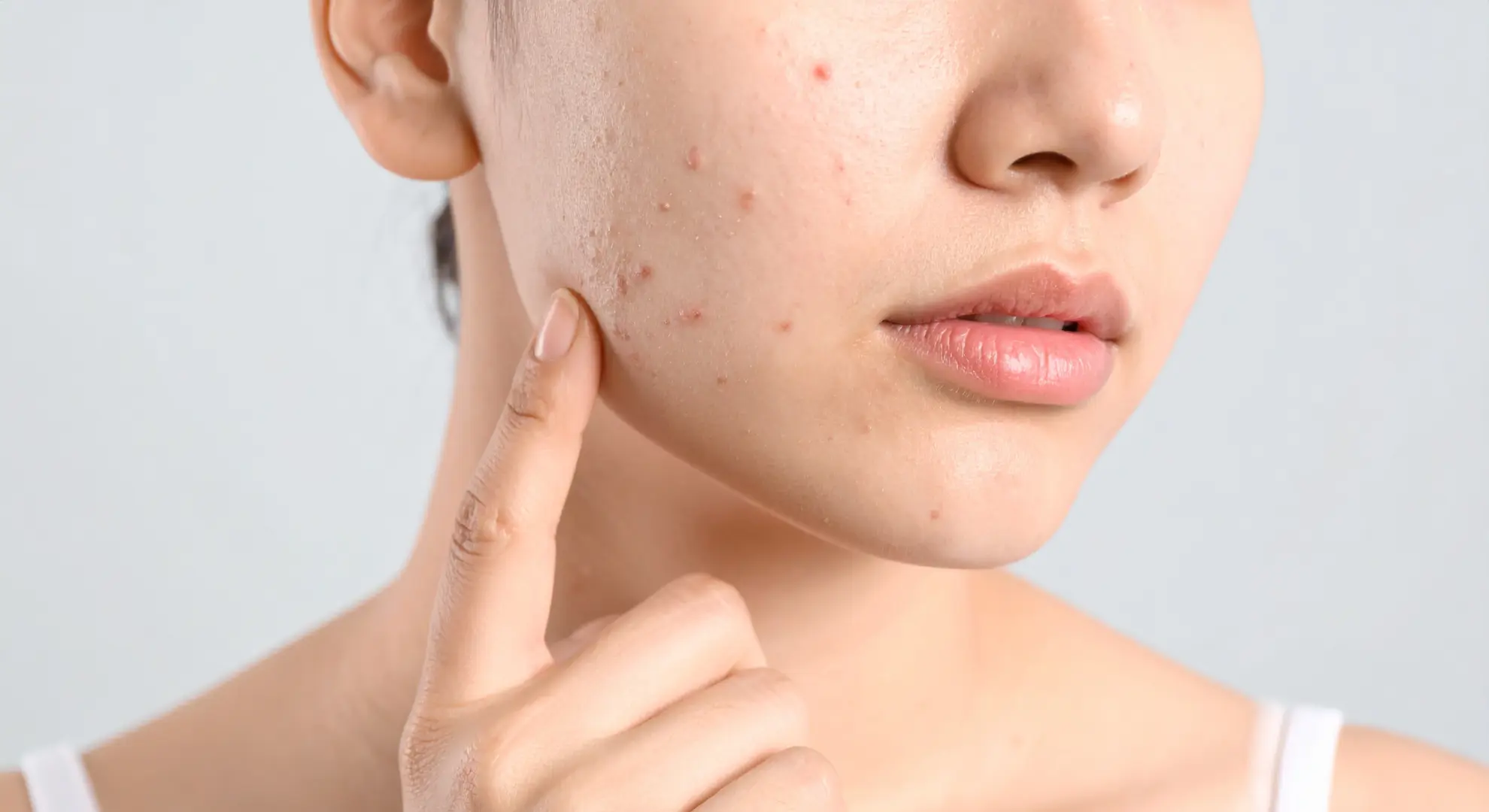 Akne-neigende und unreine Haut – Beratung, Routine und passende Pflege