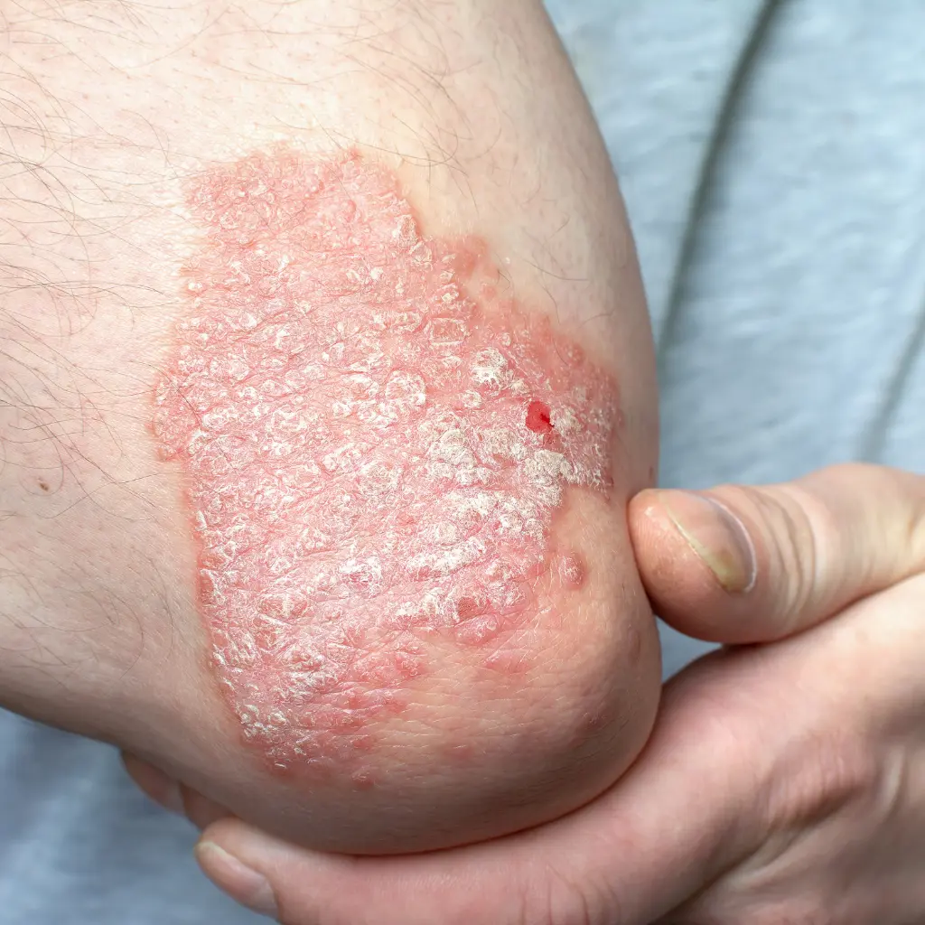 Schuppenflechte (Psoriasis) – Ratgeber und Pflegehinweise